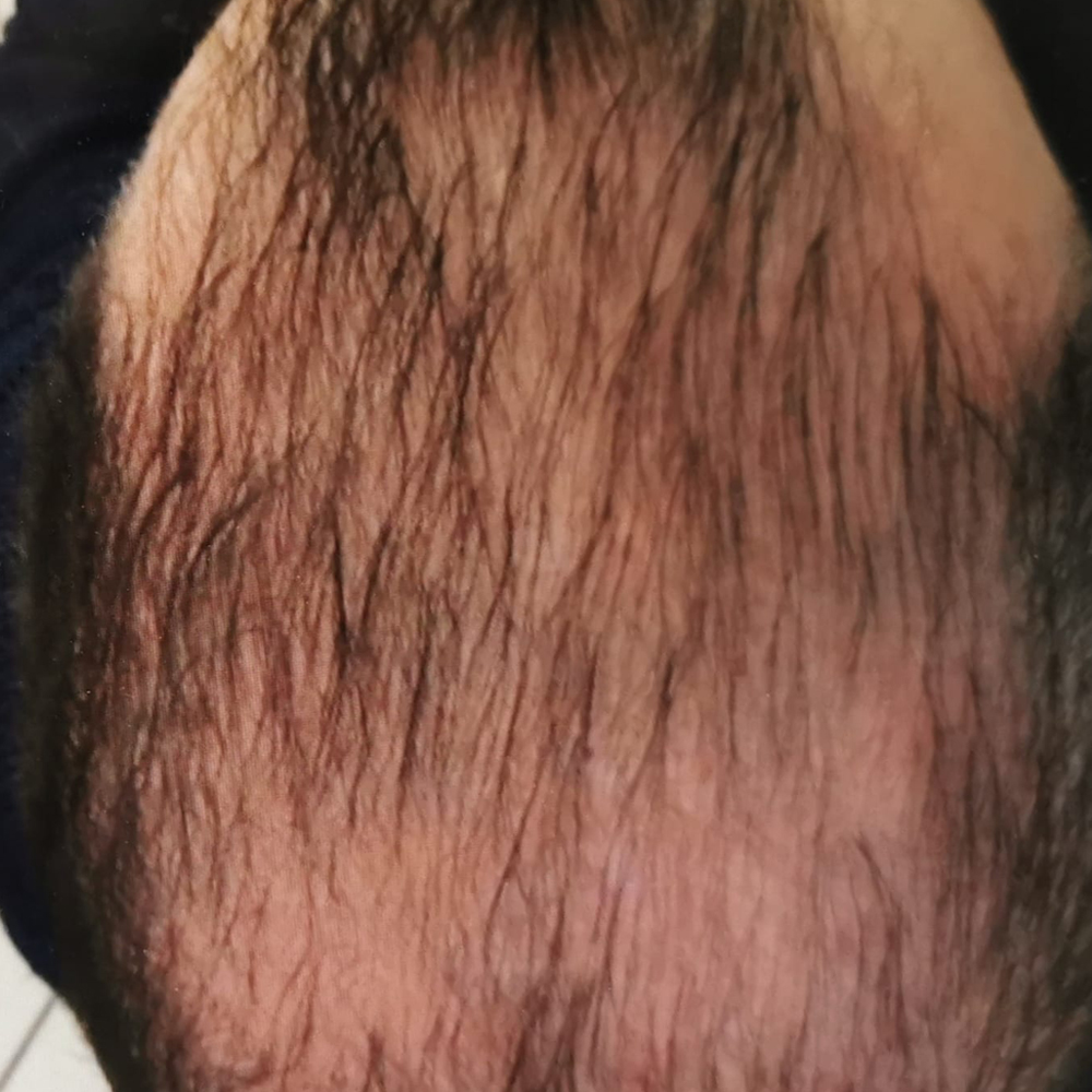 Protocollo Calvizie Trattamenti In Salone Jean Paul Myn 